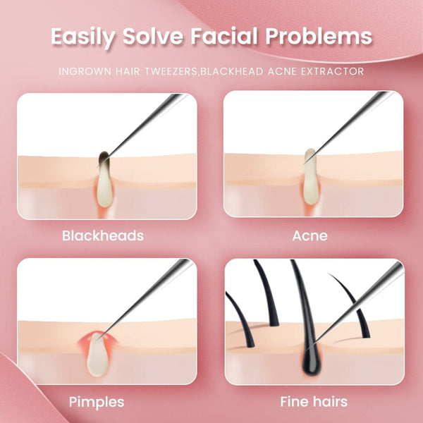 SearchFindOrder Ultra-fine No.5 Blackhead Removal Tweezers