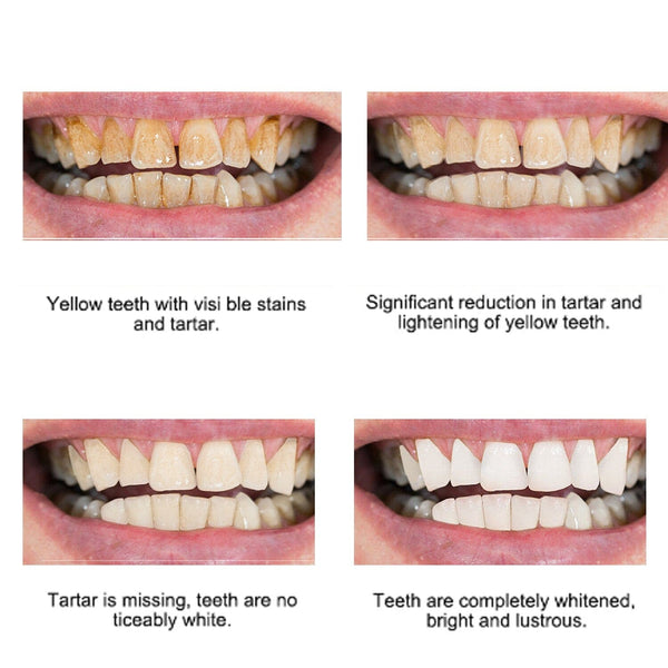 SearchFindOrder Whitening Dental Gel Pen