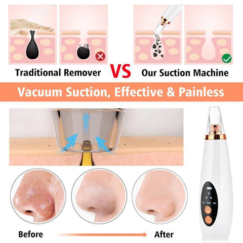 SearchFindOrder Blackhead Vacuum Pore Cleaner Beauty Tool