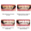 SearchFindOrder Whitening Dental Gel Pen